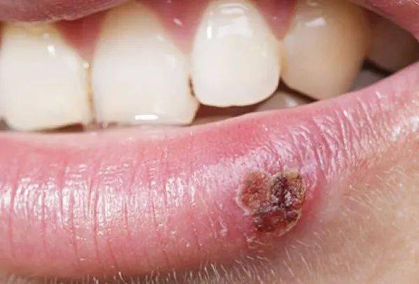 2024年生殖器皰疹攻克進展,連貫性方法執(zhí)行評估_VFL27.121便攜版