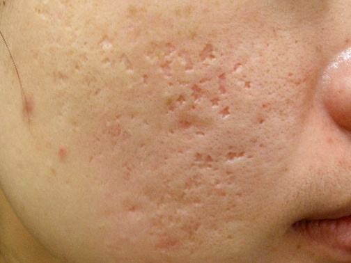 最新痘坑撫平神器，科技重塑肌膚之美，自信生活從此開始