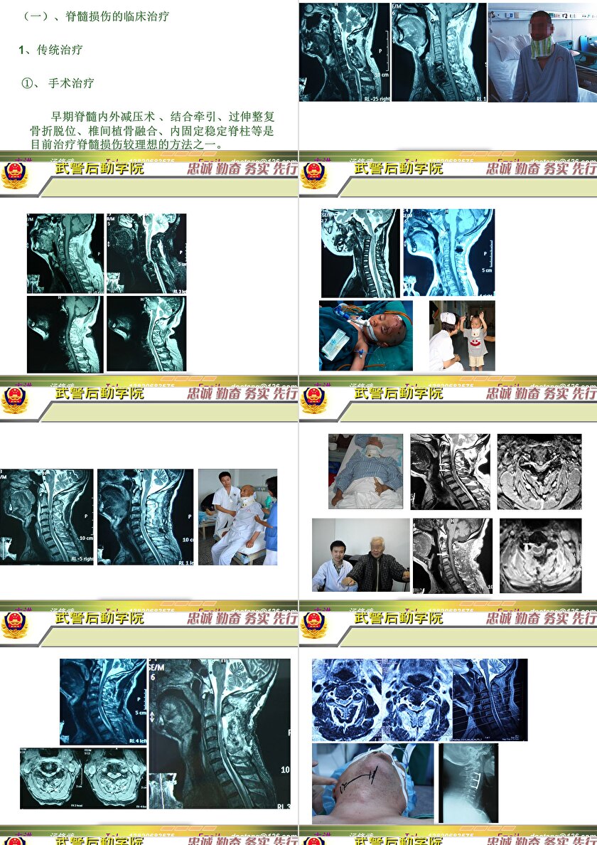 2023年脊髓損傷研究新進(jìn)展，里程碑式的突破與日常奇妙變化