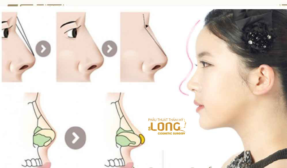 最新鼻整形技術(shù)重塑自信，煥發(fā)新生之美