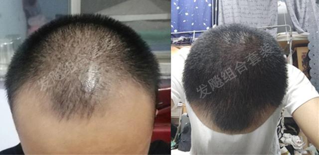 治愈脫發(fā)最新重大突破，重塑自信，希望之光再現(xiàn)